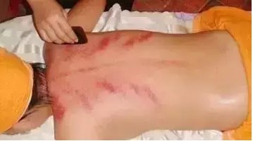 刮痧