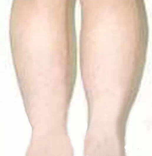 人病腿先知，从腿部（图）预测出身体的疾病