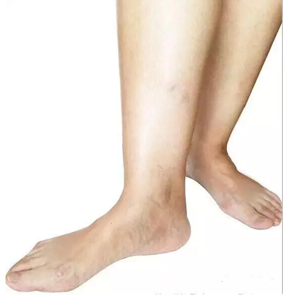 人病腿先知，从腿部（图）预测出身体的疾病