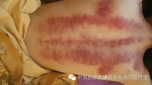 刮痧
