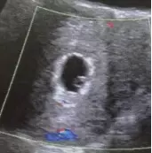 早孕囊、假孕囊与空孕囊