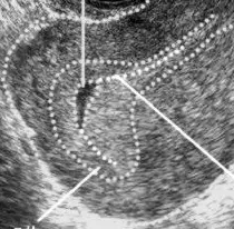 早孕囊、假孕囊与空孕囊