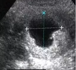 早孕囊、假孕囊与空孕囊