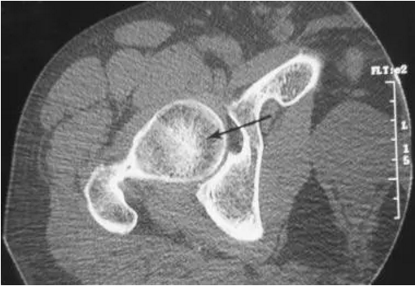 股骨头缺血坏死