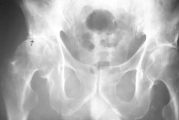 股骨头缺血坏死