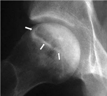 股骨头缺血坏死
