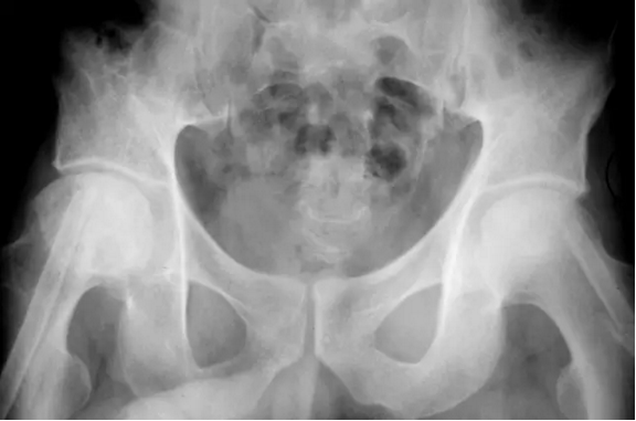 股骨头缺血坏死