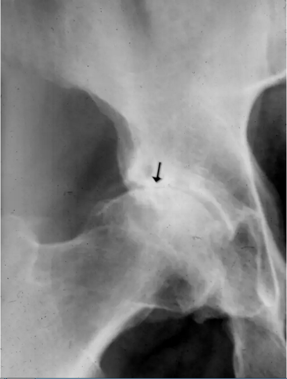 股骨头缺血坏死