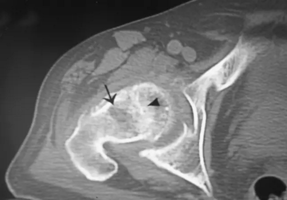 股骨头缺血坏死