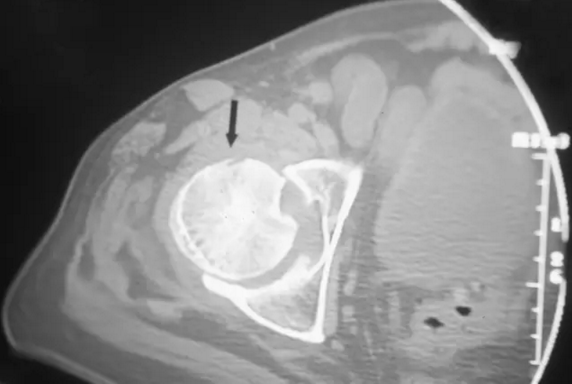 股骨头缺血坏死