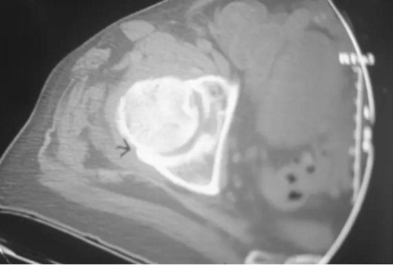 股骨头缺血坏死