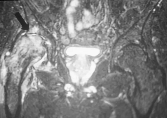 股骨头缺血坏死