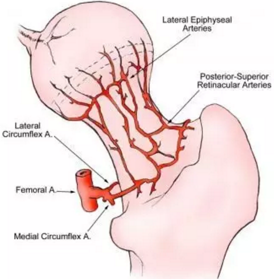股骨头缺血坏死
