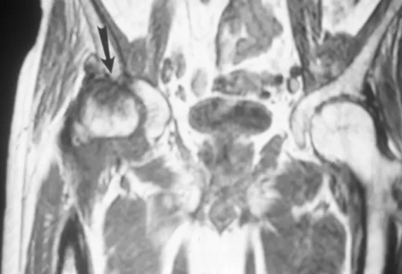 股骨头缺血坏死