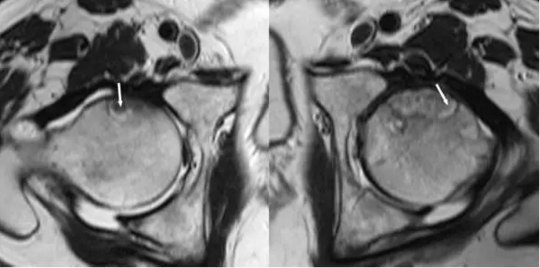 股骨头缺血坏死
