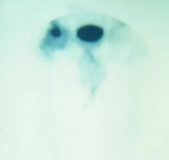 股骨头缺血坏死