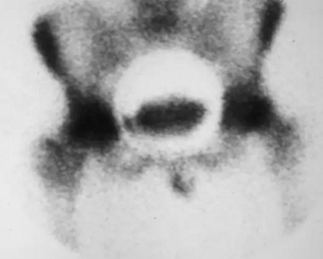 股骨头缺血坏死