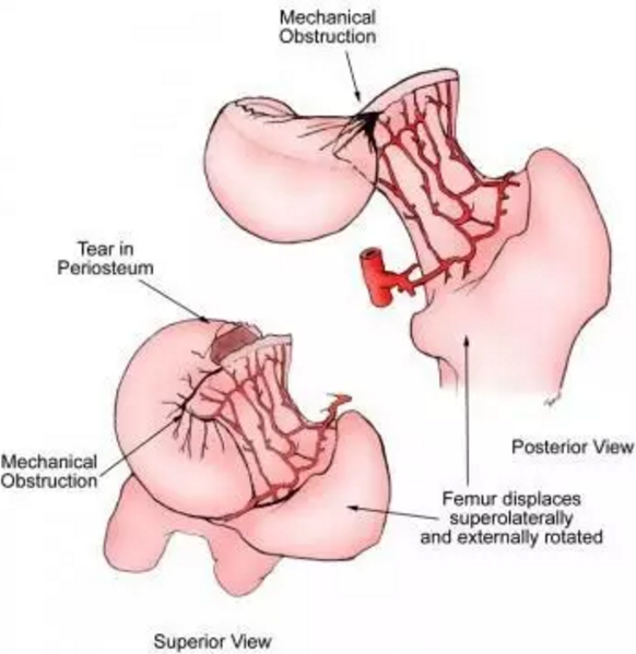 股骨头缺血坏死