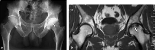 股骨头缺血坏死