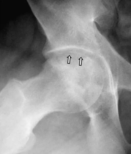 股骨头缺血坏死