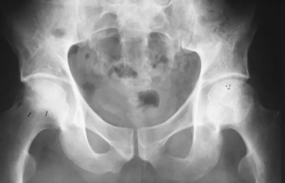 股骨头缺血坏死