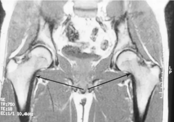 股骨头缺血坏死