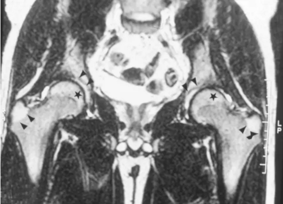 股骨头缺血坏死