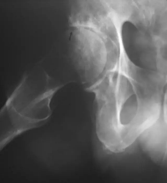 股骨头缺血坏死