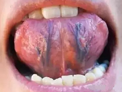 卷舌头从舌下静脉看身体淤堵程度