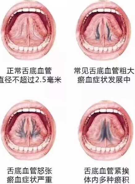 卷舌头从舌下静脉看身体淤堵程度