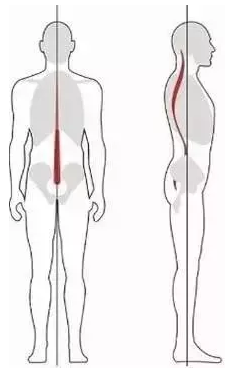 脊柱侧弯的自我康复方法