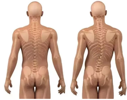 脊柱侧弯的自我康复方法