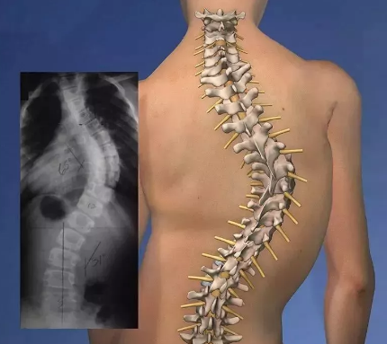 脊柱侧弯的自我康复方法