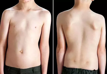 脊柱侧弯的自我康复方法